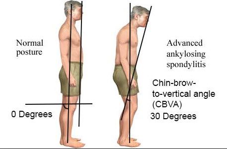 ankylosing spondylitis